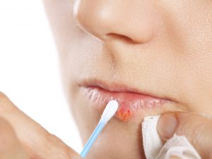 how to treat cold sore lede