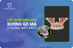 Cấy ghép implant xương gò má (Zygoma Implants) là gì