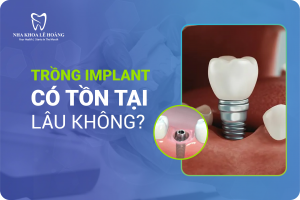 Implant có tồn tại được lâu không - nha khoa lê Hoàng