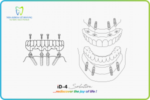cấy ghép implant toan all on 4